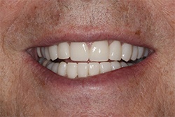 Close up of smile with flawless teeth