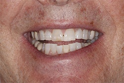 Close up of smile with imperfect teeth