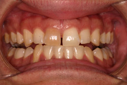 Close up of smile with imperfect teeth