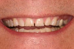 Close up of smile with imperfect teeth