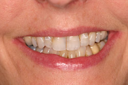 Close up of smile with imperfect teeth