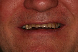 Close up of smile with imperfect teeth