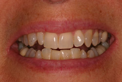 Close up of smile with imperfect teeth