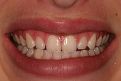 Close up of smile with imperfect teeth