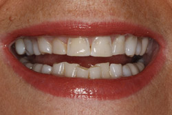 Close up of smile with discolored teeth