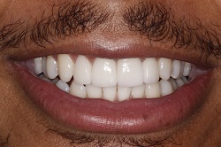 Close up of smile with flawless teeth