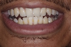 Close up of smile with imperfect teeth