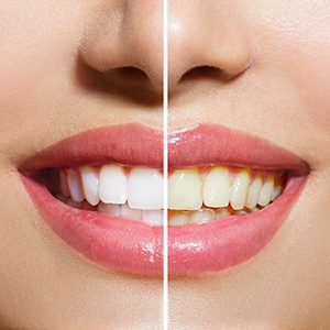 Close up of a smile before and after teeth whitening