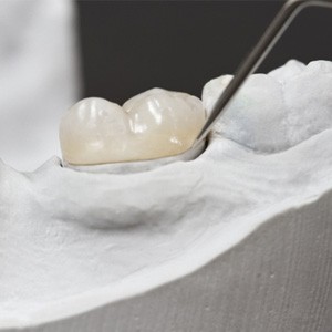 Dental tool crafting dental crown on mold of teeth