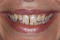 Close up of smile with imperfect teeth