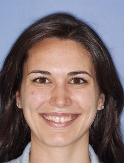 Dental patient smiling with imperfect teeth