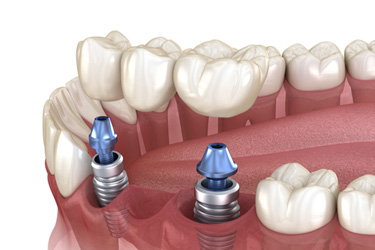 Illustration of an implant bridge