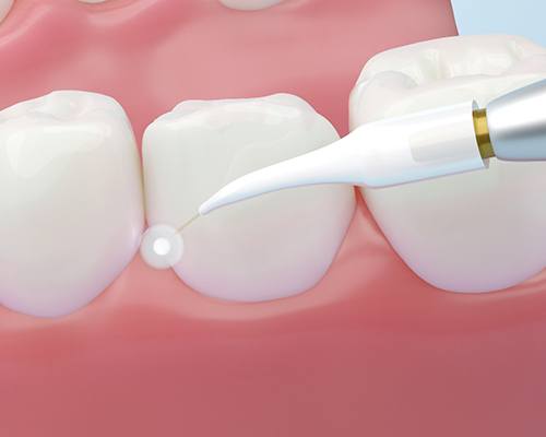 a 3D illustration of a dental laser working on gums