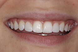 Close up of smile after cosmetic dental bonding