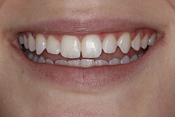 Close up of smile with imperfect teeth