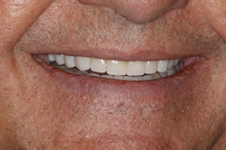 Close up of smile with flawless teeth