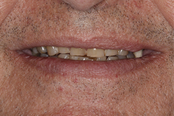 Close up of smile with imperfect teeth