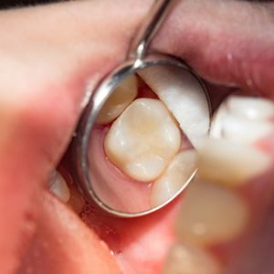 a dental mirror reflecting a tooth with a cavity filling