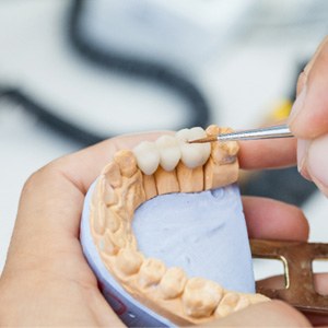 a dental bridge on a plaster mold of a mouth