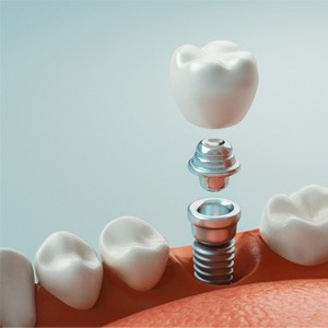 a digital illustration showing an implant crown