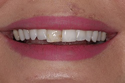 Close up of smile with imperfect teeth