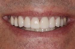 Close up of smle with flawless teeth