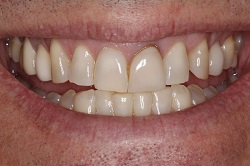 Close up of smile with imperfect teeth