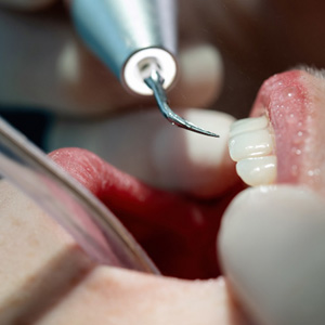 A closeup of a mouth receiving scaling and root planing