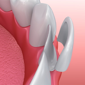 Animated veneer being placed onto a tooth