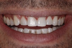 Close up of smile after cosmetic dental bonding