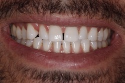 Close up of smile before cosmetic dental bonding