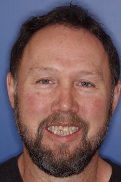 Dental patient smiling with imperfect teeth