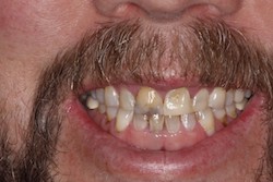 Close up of smile with imperfect teeth