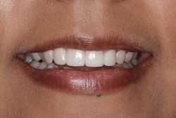 Close up of smile with flawless teeth