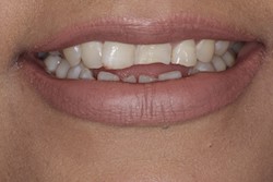 Close up of smile with imperfect teeth