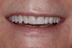 Close up of smile with imperfect teeth