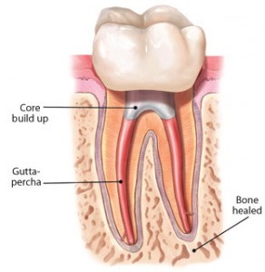 root-canal-treatment