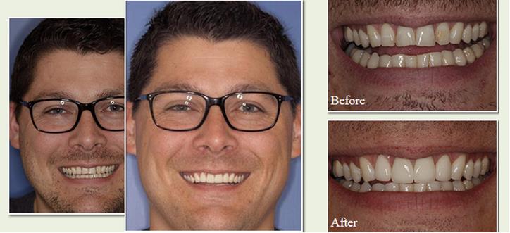 Before & After Veneer Photos of a actual patient of Dr. Robert Mitchell, D.D.S.