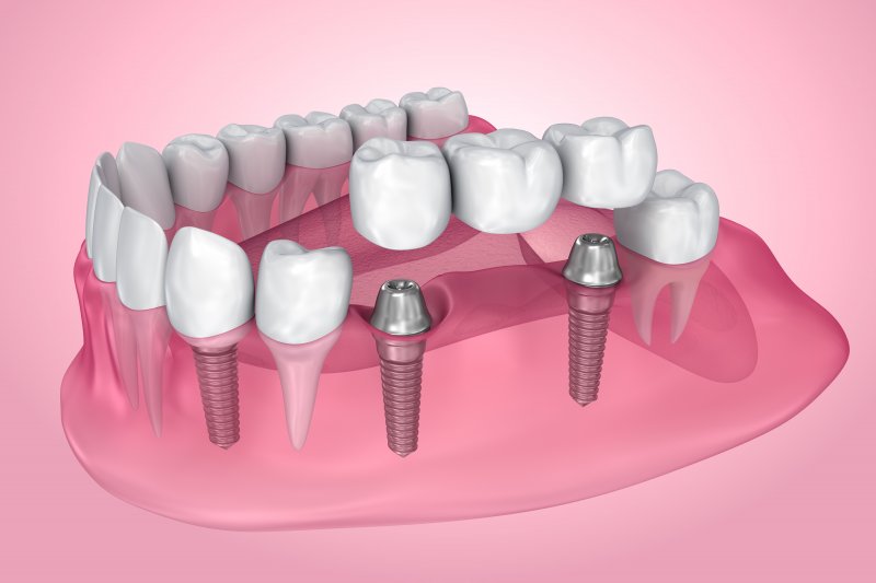 Illustration of dental implants with crown and bridge